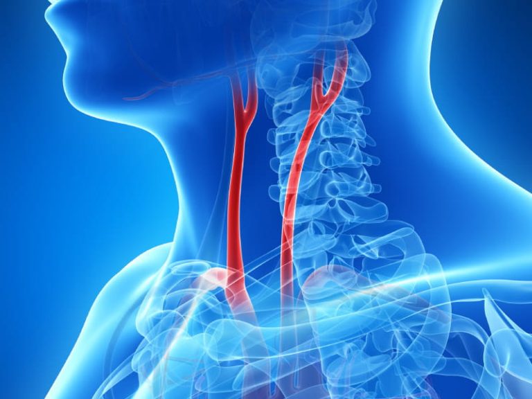 What causes clogged arteries in the neck?